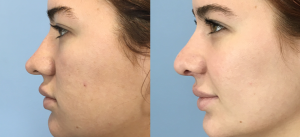 Rhinoplasty Before & After Patient Miniature Set