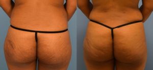 Brazilian Butt Lift Before & After Patient Miniature Set