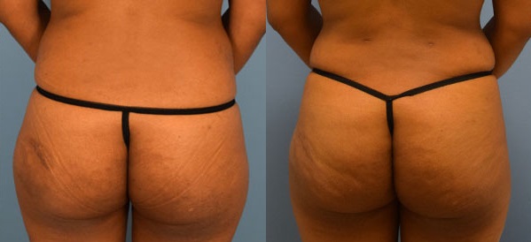 Brazilian Butt Lift Before & After Patient Set
