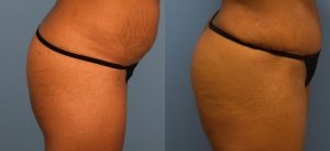 Brazilian Butt Lift Before & After Patient Miniature Set
