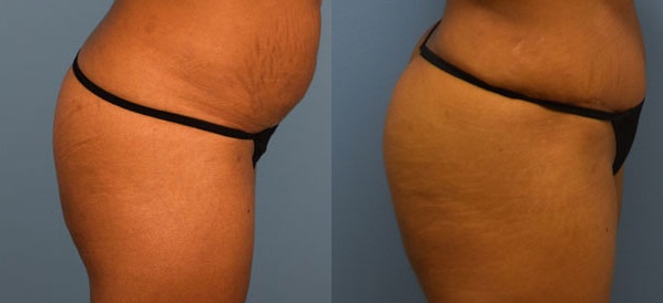 Photo of the patient’s body before & after the Brazilian Butt Lift surgery. Set 3: Patient 2