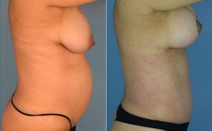 Mommy Makeover Before & After Patient Miniature Set