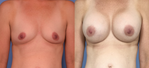 Breast Augmentation with Implants Before & After Patient Miniature Set