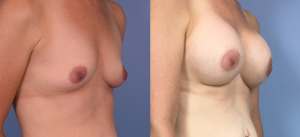 Breast Augmentation with Implants Before & After Patient Miniature Set