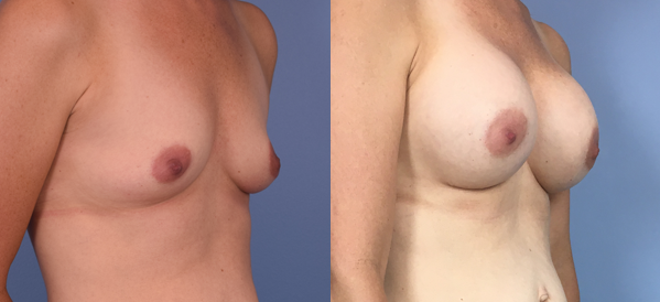 Photo of the patient’s body before & after the Breast Augmentation with Implantst surgery. Set 2: Patient 4