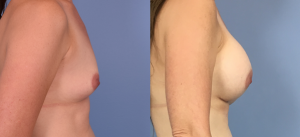 Breast Augmentation with Implants Before & After Patient Miniature Set