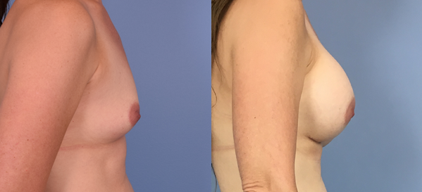 Photo of the patient’s body before & after the Breast Augmentation with Implantst surgery. Set 3: Patient 4