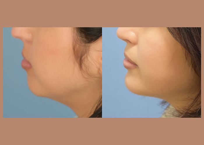 chin-implants-facial-contouring-ba