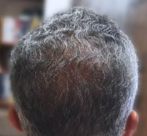 Mens's hair transplant, after treatment, front view