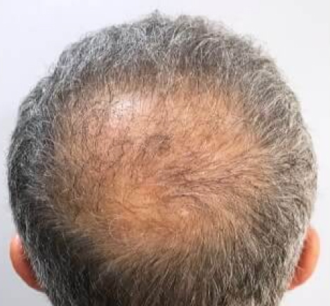 Mens's hair transplant, before treatment, front view