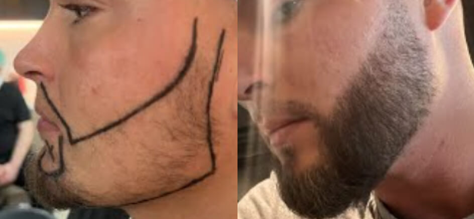 Photo of the patient’s head before & after the Male Hair Transplant surgery. Set 1: Patient 9