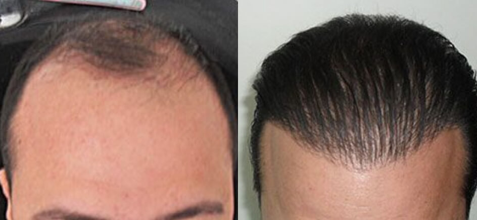 Photo of the patient’s head before & after the Male Hair Transplant surgery. Set 1: Patient 3