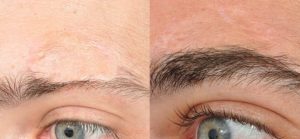 Male Hair Transplant Before & After Patient Miniature Set