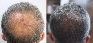 Male Hair Transplant Before & After Patient Miniature Set