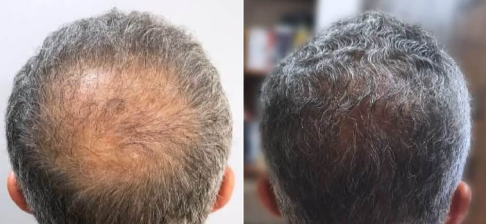 Photo of the patient’s head before & after the Male Hair Transplant surgery. Set 1: Patient 1