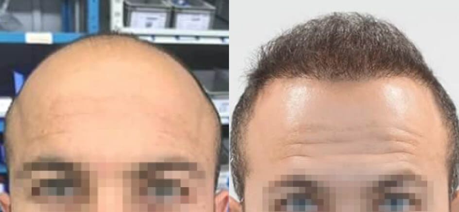 Photo of the patient’s head before & after the Male Hair Transplant surgery. Set 1: Patient 4