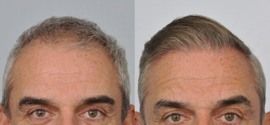 Photo of the patient’s head before & after the Male Hair Transplant surgery. Set 1: Patient 5