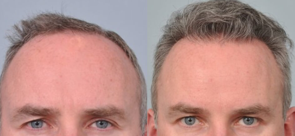 Photo of the patient’s head before & after the Male Hair Transplant surgery. Set 1: Patient 6