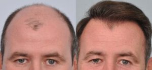 Male Hair Transplant Before & After Patient Miniature Set