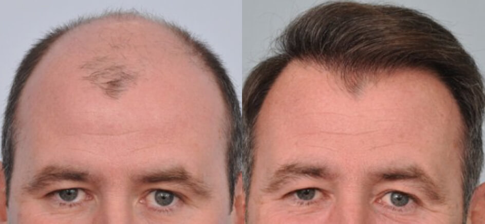 Photo of the patient’s head before & after the Male Hair Transplant surgery. Set 1: Patient 7