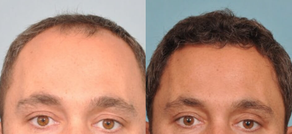 Photo of the patient’s head before & after the Male Hair Transplant surgery. Set 1: Patient 8