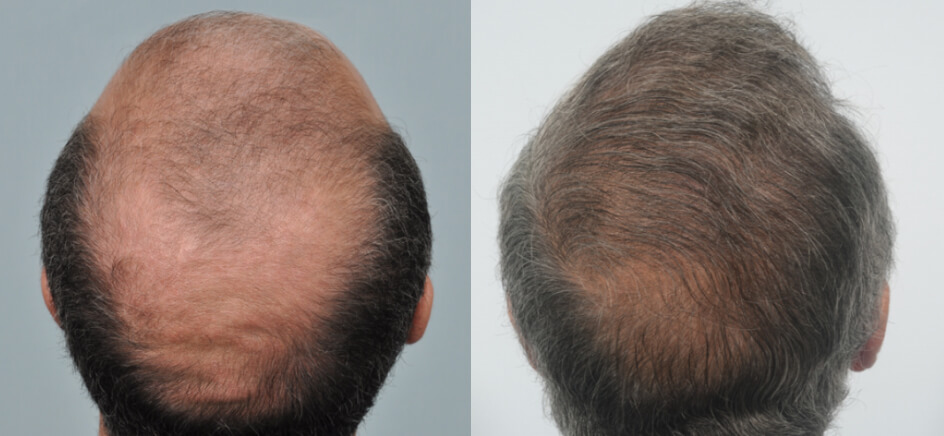 Photo of the patient’s head before & after the Male Hair Transplant surgery. Set 1: Patient 2