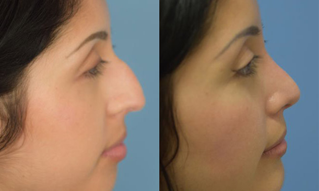 rhinoplasty-pat12-set1post