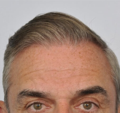 Male Hair, after Male Hair Restoration treatment, oblique view, patient 1