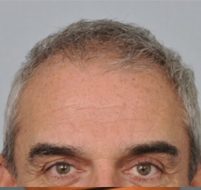Male Hair, before Male Hair Restoration treatment, oblique view, patient 1